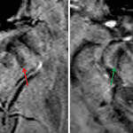 Loss of the normal hyperintense signal on SWI in nigrosome-1 in the patient with Parkinson disease on the left (red arrows) compared to an age-matched control on the right (green arrows).