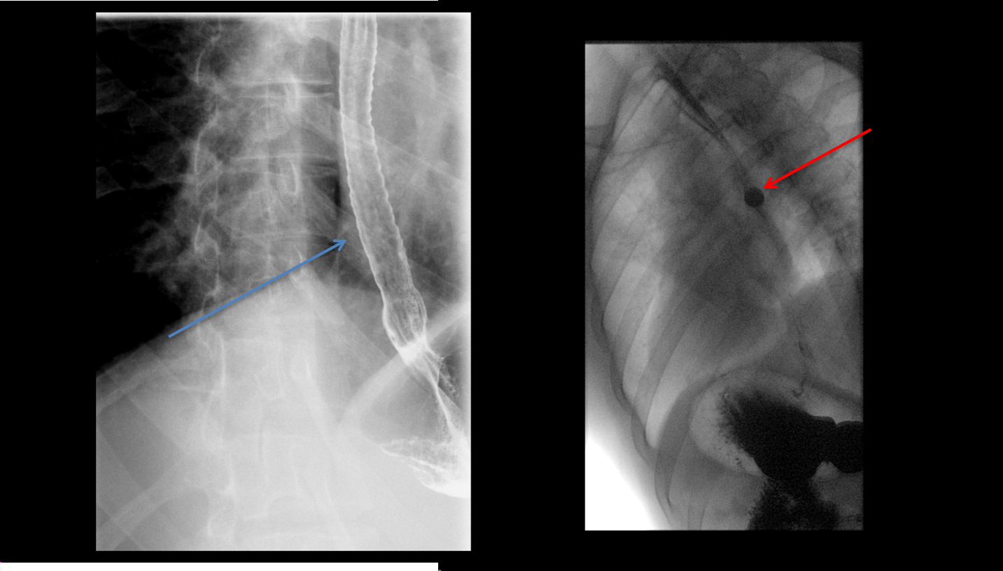Esophagus with long segment narrowing, with corrugated appearance (blue arrow). 13 mm barium pill is unable to traverse the stricture (red arrow).