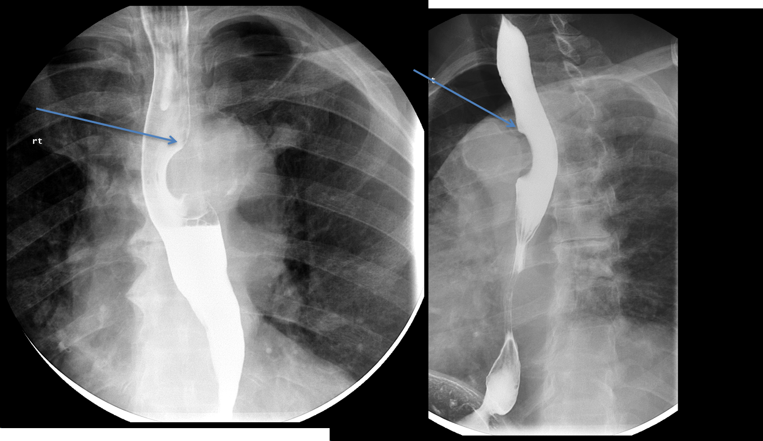 Image show a smooth filling defect in the esophagus. There are obtuse margins between the mass and the esophagus (blue arrow)