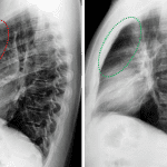 Loss of the retrosternal clear space in this patient (red dotted area) compared to a normal lateral chest radiograph in a different patient (green dotted area).