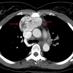 Contrast-enhanced chest CT in this patient confirms a retrosternal thyroid mass (red arrows).