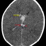 Abnormal hyperdensity in the bilateral internal cerebral veins (red arrows) as well as in linear structures adjacent to a hematoma at the right caudothalamic groove (yellow arrow) likely representing thalamostriate veins. These findings are concerning for deep venous thrombosis and associated hemorrhage.