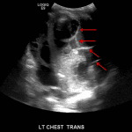 Complex left pleural fluid collection with echogenic internal septations (red arrows), concerning for an empyema.