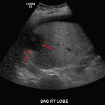 Ill-defined hypoechoic structure in the periphery of the right hepatic lobe (red arrows) concerning for a hepatic abscess.