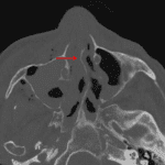 Abrupt angulation of the nasal septum anteriorly (red arrow) concerning for acute fracture.