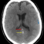Hyperdense appearance of the vein of Galen (red arrow) and straight sinus (yellow arrow) concerning for thrombosis. Scattered areas of sulcal hyperattenuation (e.g. at the blue arrow), which may represent trace subarachnoid hemorrhage or additional small thrombosed veins.
