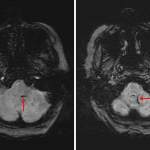 Linear susceptibility artifact associated with vessels coursing along the inferior aspect of the left cerebellar hemisphere (red arrows), which may represent thrombus within PICA branches versus increased deoxyhemoglobin content in draining cortical veins.