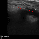 Findings consistent with acute appendicitis including appendiceal distension (measuring 12 mm in diameter on this image), wall thickening, and a shadowing appendicolith (red arrows).