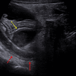 Dilated appendix with mild wall thickening (red arrows). Superficial to the appendix is a hypoechoic structure (yellow arrow), which did not show internal vascularity on color Doppler analysis and is concerning for an abscess.