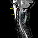 Atlantooccipital dissociation: Red arrow: upper cervical cord and medullary contusion. Purple arrows: edema in the anterior and posterior atlantooccipital membranes. Yellow arrows: prevertebral edema/hematoma. Blue arrows: edema in the interspinous ligament. Green arrows: edema in the nuchal ligament.