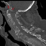 Cortical offset and fragmentation of the basiocciput (red arrows) consistent with acute impacted fractures superimposed on degenerative changes.
