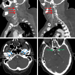 Subsequent CTA in this patient shows occlusion of the bilateral cervical internal carotid arteries at their origins (red arrows), which remain occluded through their petrous (blue arrows) and cavernous segments with supraclinoid reconstitution (green arrows).