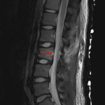 Posterior bowing of the edematous posterior cortex of the L3 vertebral body results in focal uplifting of the posterior longitudinal ligament (red arrow).