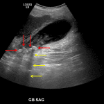 Multiple hyperechoic gallstones layering in the gallbladder (red arrows) with associated posterior acoustic shadowing (yellow arrows).