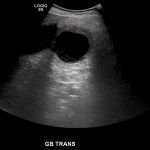 Gallbladder wall thickening (red dotted line). Hypoechoic appearance of the gallbladder wall is indicative of edema.