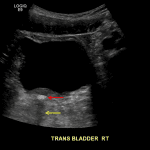 Echogenic structure near the right ureterovesicular junction (red arrow) with associated posterior acoustic shadowing (yellow arrow), concerning for a distal ureteral calculus.