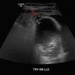 Focal mural discontinuity at the gallbladder fundus (red arrow) concerning for gangrenous change.