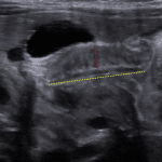 Increased single wall muscle thickness (red dotted line) and elongated pyloric channel (yellow dotted line), supportive of a diagnosis of hypertrophic pyloric stenosis.