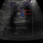 Preserved flow on color Dopper analysis within the intussusceptum (red arrows). Although this is a reassuring finding, the patient is still at risk for bowel ischemia if the intussusception is not reduced.