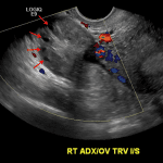 Enlarged right ovary with peripheralization of ovarian follicles (red arrows) and near complete loss of internal ovarian vascularity, consistent with ovarian torsion.