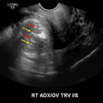Heterogeneous echogenic mass along the medial aspect of the right ovary with internal echogenic dots (red arrows) and dashes (yellow arrows), consistent with a dermoid cyst.