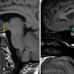 Sagittal T1-weighted midline images from this patient (on left) and a comparison normal patient (on right) showing normal T1 signal hyperintensity in the posterior pituitary in both patients (yellow arrows) but abnormal patchy T1 signal hyperintensity in the anterior pituitary in this patient (red arrow) compared to the homogeneous signal in the normal control (green arrow), raising concern for hemorrhage either within or coating the gland.