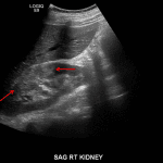 Area of cortical hyperechogenicity in the interpolar right kidney with decreased corticomedullary differentiation (red arrows), concerning for pyelonephritis.