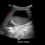 Fluid-debris level in the dilated right renal pelvis (red arrow), worrisome for pyonephrosis.