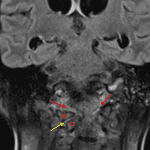 Abnormal FLAIR signal hyperintensity in the right greater than left atlantooccipital joints (red arrows) and in the right atlantoaxial joint (yellow arrow) with lateral subluxation of the lateral mass of C1 on the lateral mass of C2.