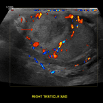 Hypoechoic lesion in the right testis with peripheral but no central Doppler flow (red arrow), which is concerning for a testicular abscess in the setting of epididymo-orchitis.