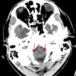 Inferior descent of the cerebellar tonsils into the foramen magnum (red arrows) with associated mild crowding at the cervicomedullary junction.