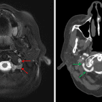 Abnormal flow-related signal (hyperintense on T2-weighted imaging) in the extradural left vertebral artery (red arrows) relative to the right (green arrows), which is confirmed on a subsequent CTA in this patient (image on the right).