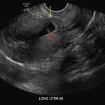 Gestational sac located within the C-section scar in the anterior wall of the lower uterine segment (red arrow) with overlying mural thinning (yellow arrow).