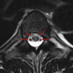 Flow-related signal loss (aka flow voids) related to movement of CSF (red arrows), which are important not to confuse for pathology.