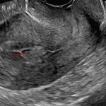 Echogenic mass centered in and focally expanding the endometrial canal (red arrow).