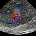 Color Doppler analysis shows vascularity extending from the myometrium into this mass (red arrow), which is highly suggestive of retained products of conception in the correct clinical context. In a different context, an endometrial polyp could have a similar appearance.