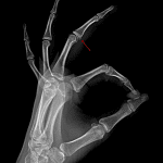 Volar plate avulsion fracture (red arrow)