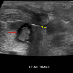 Complex collection concerning for abscess (red arrow) with a linear echogenic structure along the superficial margin with associated posterior acoustic shadowing (yellow arrow), concerning for a linear array of gas versus foreign body.