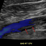 Echogenic material located peripherally within the vessel lumen (red arrows) with preservation of blood flow centrally, which is a typical appearance for chronic, recanalized DVT.