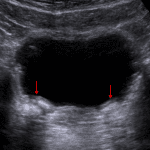 Bilateral deflux mounds resulting in a bulging contour of the bladder wall at the ureterovesicular junctions (red arrows). These demonstrate areas of calcification with posterior acoustic shadowing, which can be confused for ureteral calculi.