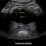 Echogenic structure near the anterior wall of the bladder (red arrow) with ring-down artifact (yellow arrows), which is a typical appearance for gas near or within the bladder wall.