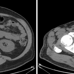 Followup noncontrast CT in this patient confirms right renal collecting system gas (red arrow) and gas in the urinary bladder (yellow arrow).