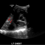 Multiple punctate and linear echogenic foci in the left lung (red arrows), consistent with air bronchograms.