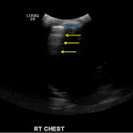 Ultrasound evaluation of the normal right lung in this patient shows the pleural line (blue arrow) with multiple ripple-like echogenic lines extending deep (yellow lines), which are referred to as A-lines.