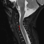 Trace heterogeneous STIR signal material along the dorsal margin of the C3 vertebral body with focal ligamentous uplifting and impression on the thecal sac (red arrow), likely representing a trace epidural hematoma.
