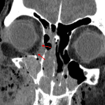 Mild extraconal fat stranding in the anteromedial and anteroinferior right orbit (red arrows).