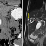 Noncontrast CT (on left) and T2-weighted MRI (on right) show a complex lesion in the right hepatic lobe (red arrows) with peripheral calcification best seen on CT and internal cystic areas best seen on MRI. Small volume adjacent perihepatic free fluid (yellow arrow).