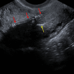 IUD stem (red arrows) extends into the myometrium in the anterior wall of the lower uterine segment, clearly separate from the endometrial canal (yellow arrow).