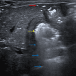 Multiple punctate and linear echogenic foci throughout the liver (red arrows), concerning for portal venous gas. Thickened, echogenic adjacent bowel wall (yellow arrow) with ill-defined posterior acoustic shadowing (blue arrows), concerning for pneumatosis.