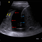 Airspace consolidation in the right lung evidenced by a liver-like appearance (note how the lung - red arrows - has a similar echotexture to the liver - blue arrows) and multiple echogenic air bronchograms (yellow arrows). The adjacent pleural fluid appears simple, likely representing a parapneumonic effusion.